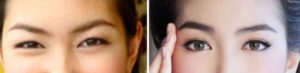 eyelid-surgery-before-after-photo